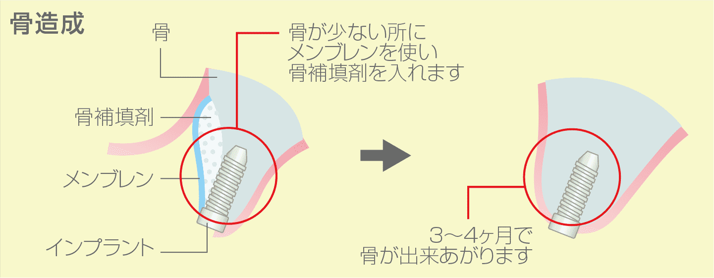 骨誘導再生療法（GBR）