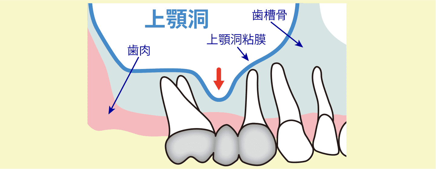 上顎洞拳上術