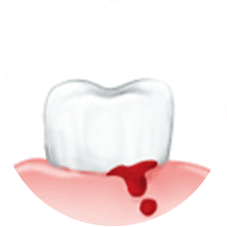 歯ぐきから血が出る