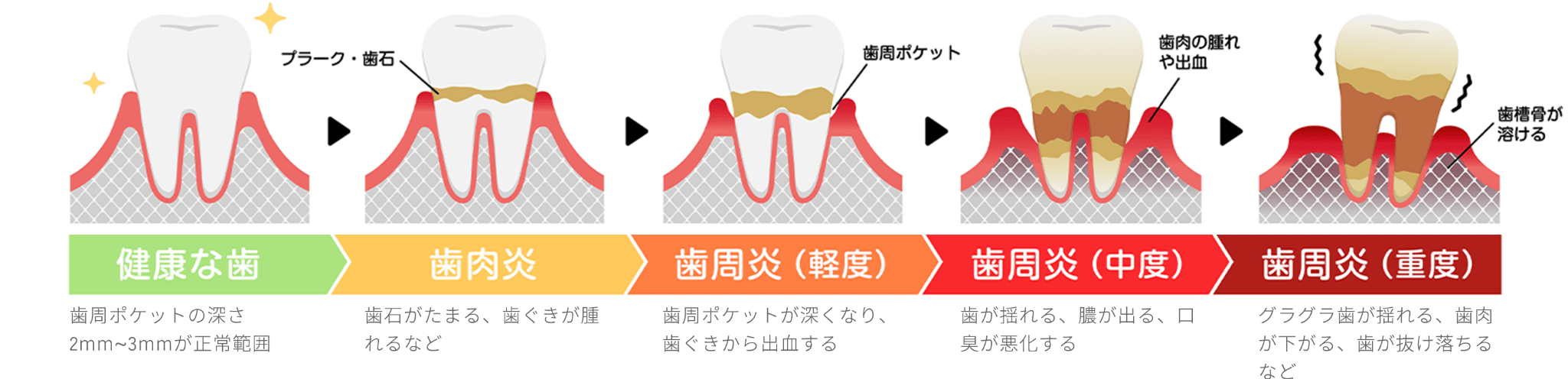 歯周病のステージとその症状 図